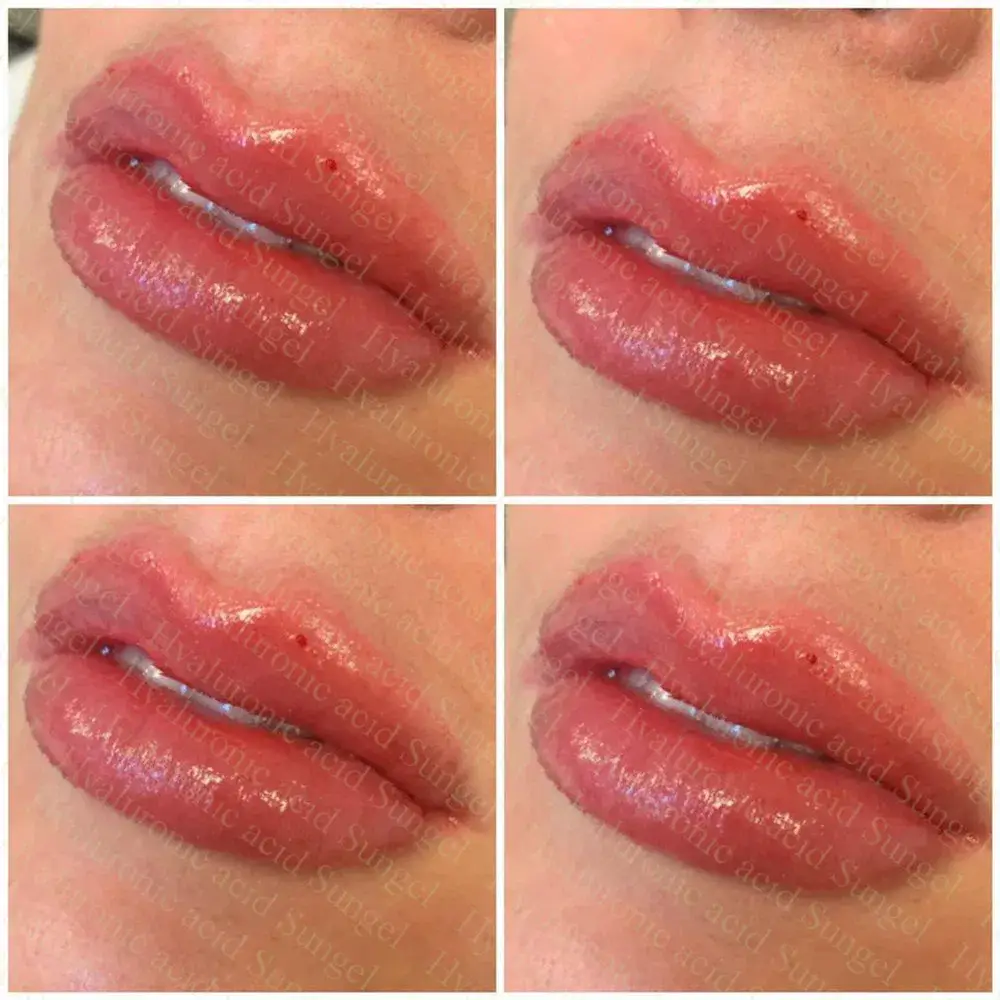 CE 1ml - Chất làm đầy tiêm liên kết chéo Axit Hyaluronic cho bút Hyaluronic tại đây