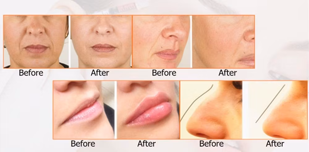 CE 1ml - Chất làm đầy tiêm liên kết chéo Axit Hyaluronic cho bút Hyaluronic tại đây hình ảnh 15-description