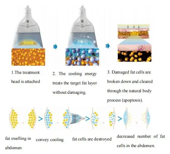Máy làm mát Cryo 5D 2021 - Thiết bị giảm mỡ không xâm lấn, hiệu quả, an toàn hình ảnh 18-description