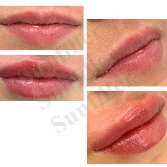 CE 1ml - Chất làm đầy tiêm liên kết chéo Axit Hyaluronic cho bút Hyaluronic tại đây