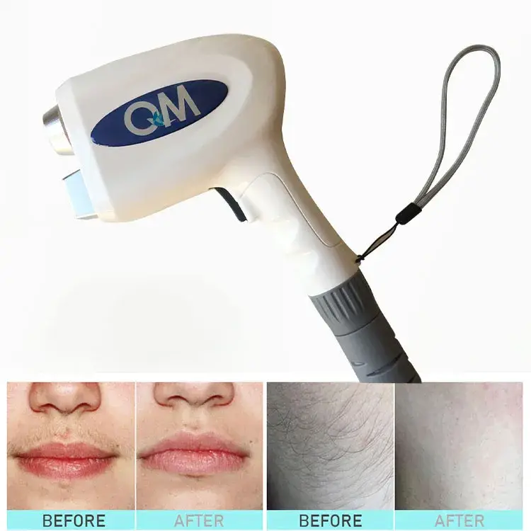 Máy Triệt Lông Bằng Laser YAG 4 trong 1: Công Suất Lớn và Hiệu Quả