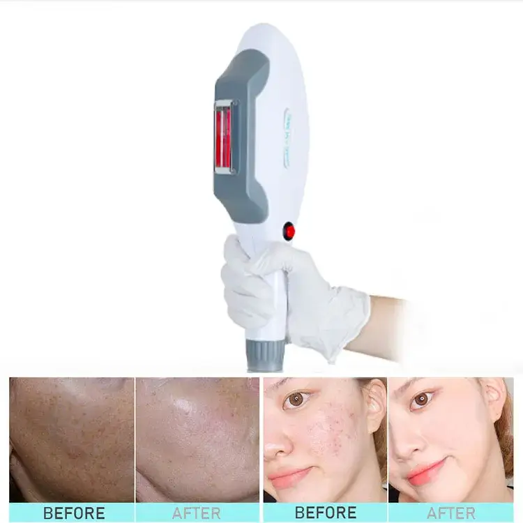 Máy Triệt Lông Bằng Laser YAG 4 trong 1: Công Suất Lớn và Hiệu Quả