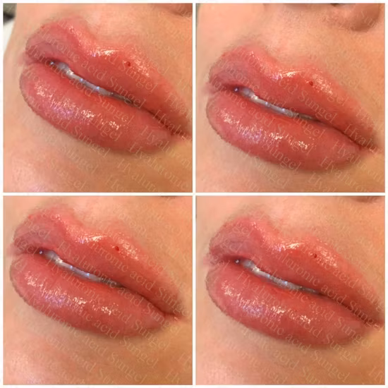 CE 1ml - Chất làm đầy tiêm liên kết chéo Axit Hyaluronic cho bút Hyaluronic tại đây