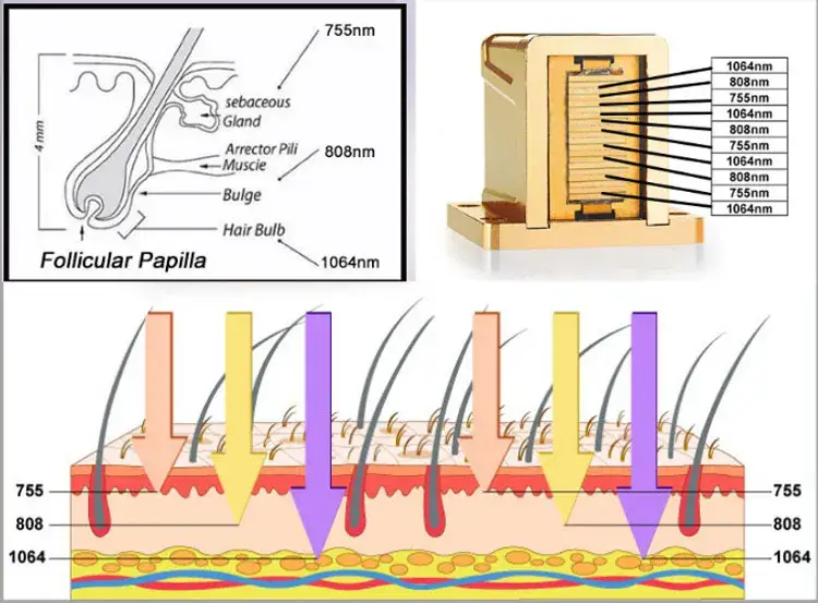 Top 5 loại kích thước điểm ba cải tiến nhất của máy triệt lông 808nm sử dụng công nghệ laser diode hình ảnh 16-description