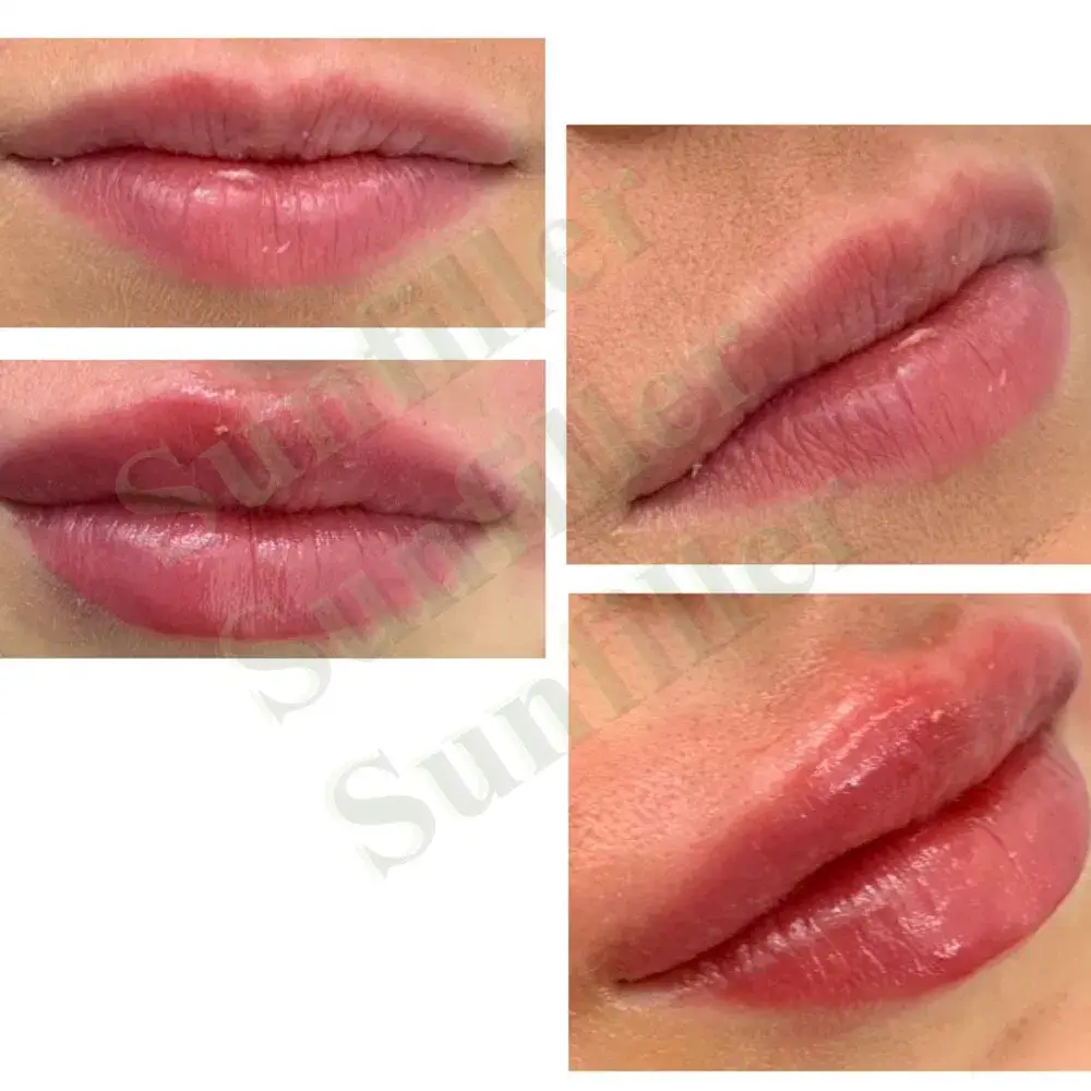 CE 1ml - Chất làm đầy tiêm liên kết chéo Axit Hyaluronic cho bút Hyaluronic tại đây