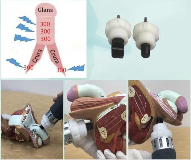 Máy kích thích cơ điện tử Shockwave và EMS - Thiết bị vật lý trị liệu 2 trong 1 cho nhà máy - Sóng xung kích và Thiết bị liệu pháp EMS hình ảnh 18-description
