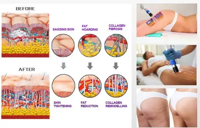 Máy kích thích cơ điện tử Shockwave và EMS - Thiết bị vật lý trị liệu 2 trong 1 cho nhà máy - Sóng xung kích và Thiết bị liệu pháp EMS hình ảnh 16-description