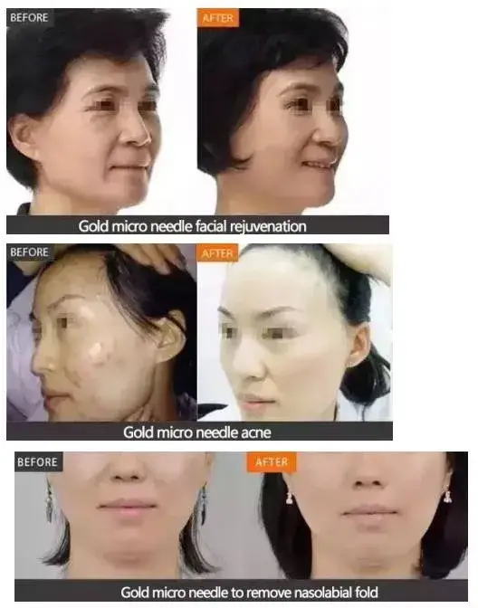 Kim lăn vàng RF 3-in-1: Phương pháp nâng cơ và làm mờ nếp nhăn hiệu quả hình ảnh 23-description