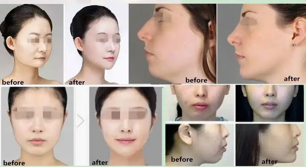 Chất làm đầy liên kết chéo tinh tế 2ml - Phương pháp tiêm dưới da cho đường nét khuôn mặt hiệu quả hình ảnh 14-description