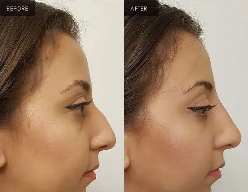 Chất làm đầy liên kết chéo tinh tế 2ml - Phương pháp tiêm dưới da cho đường nét khuôn mặt hiệu quả hình ảnh 13-description