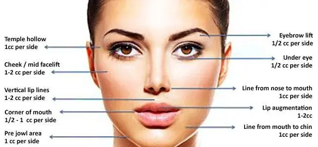 Chất làm đầy liên kết chéo tinh tế 2ml - Phương pháp tiêm dưới da cho đường nét khuôn mặt hiệu quả hình ảnh 12-description