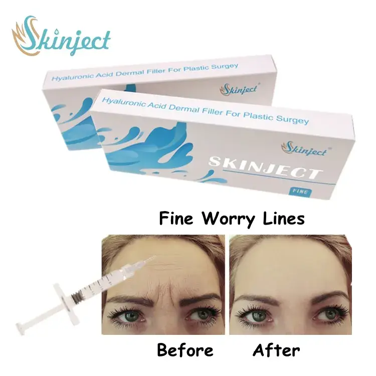 Chất làm đầy liên kết chéo tinh tế 2ml - Phương pháp tiêm dưới da cho đường nét khuôn mặt hiệu quả