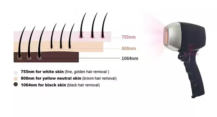 Laser Diode 755nm 808nm 1064nm: Công nghệ Laser Alexandrite mạnh mẽ và hiệu quả