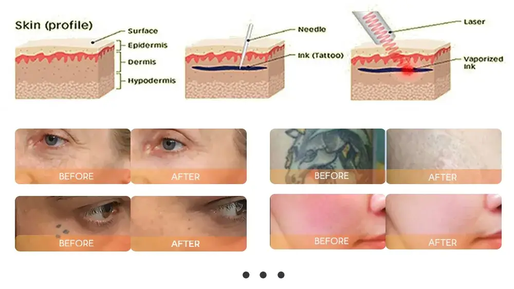 Thiết bị làm đẹp chuyên triệt lông, xóa hình xăm và trẻ hóa da với công nghệ laser diode đa chức năng IPL ND YAG hình ảnh 20-description