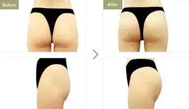 Otesaly 20ml: Axit Hyaluronic liên kết chéo cho chăm sóc cơ thể, sản phẩm tiêm ngực và mông
