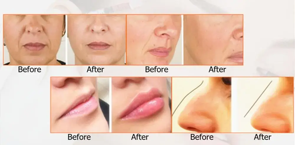 Chăm sóc da với việc tiêm chất làm đầy da trong phương pháp phẫu thuật thẩm mỹ hình ảnh 19-description