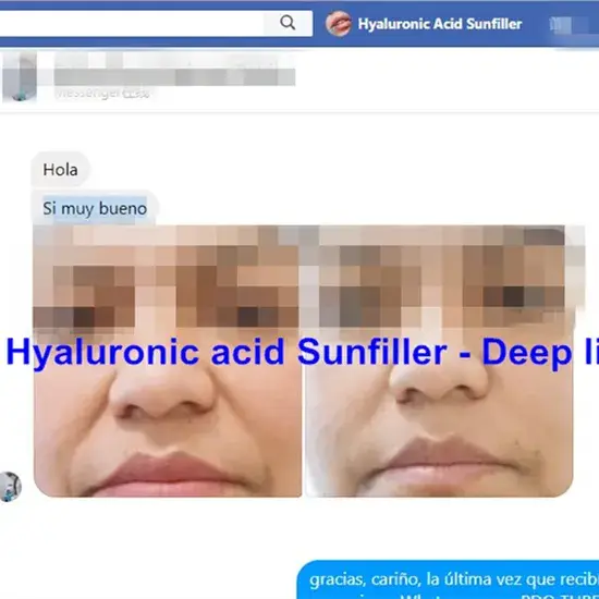 Chăm sóc da với việc tiêm chất làm đầy da trong phương pháp phẫu thuật thẩm mỹ