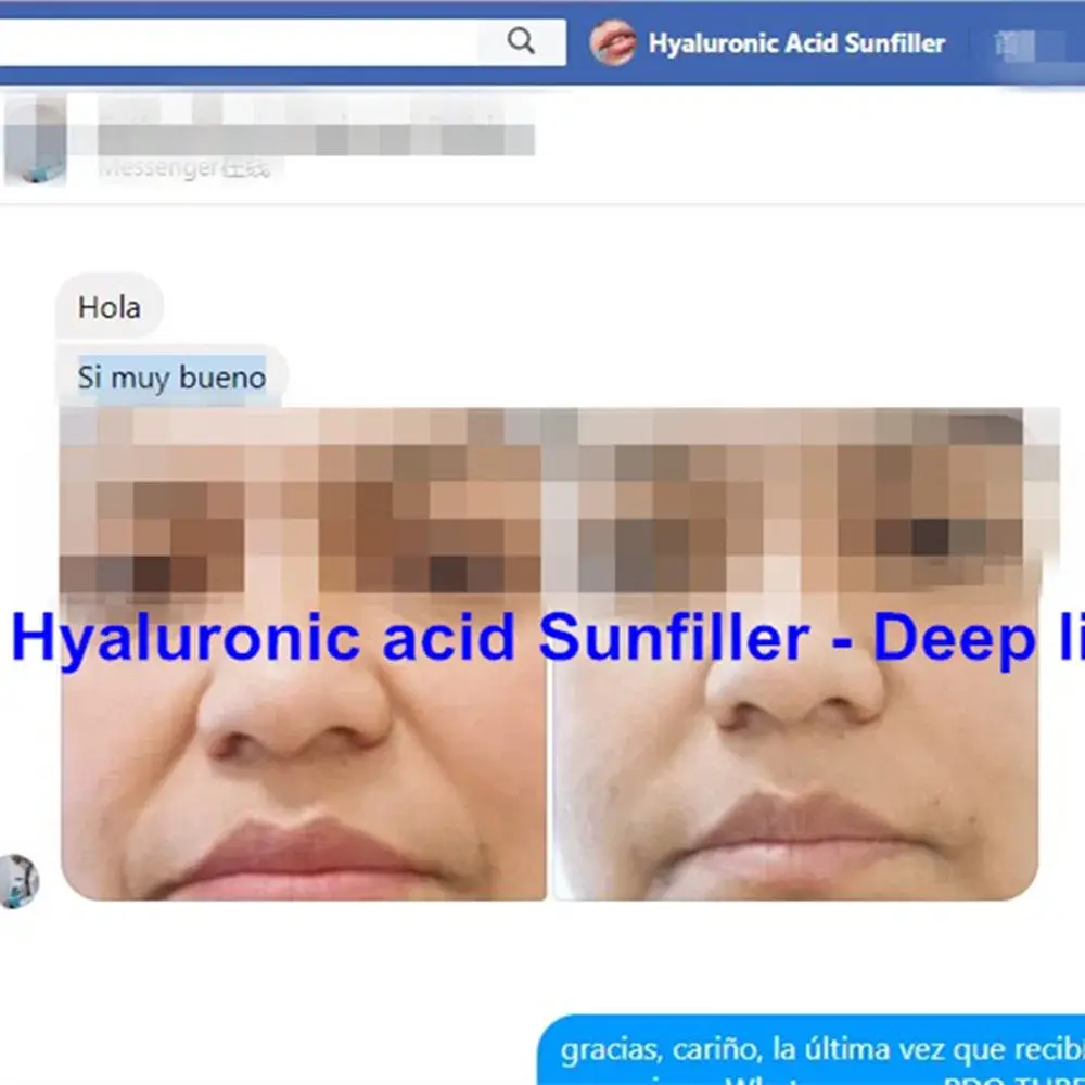 Chăm sóc da với việc tiêm chất làm đầy da trong phương pháp phẫu thuật thẩm mỹ