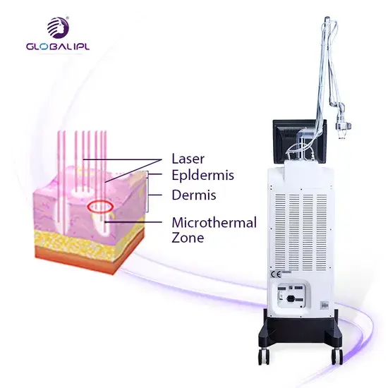 Máy Tạo Điều Kiện Laser Fractional CO2: Giúp Siết Chặt Vùng Kín hình ảnh 1-description
