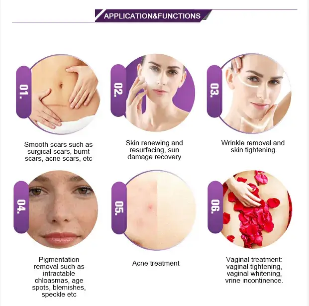 Máy Tạo Điều Kiện Laser Fractional CO2: Giúp Siết Chặt Vùng Kín hình ảnh 14-description