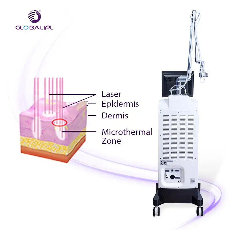 Máy Tạo Điều Kiện Laser Fractional CO2: Giúp Siết Chặt Vùng Kín