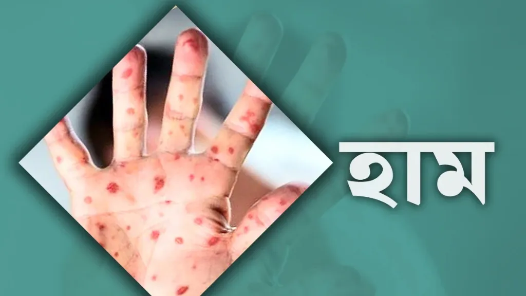 হাম ও উপসর্গে আরও ৬ মৃত্যু