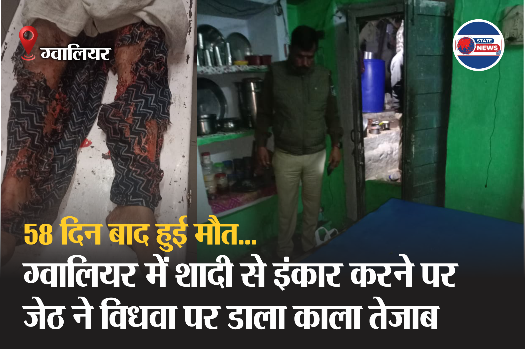 ग्वालियर में शादी से इंकार करने पर जेठ ने विधवा पर डाला काला तेजाब