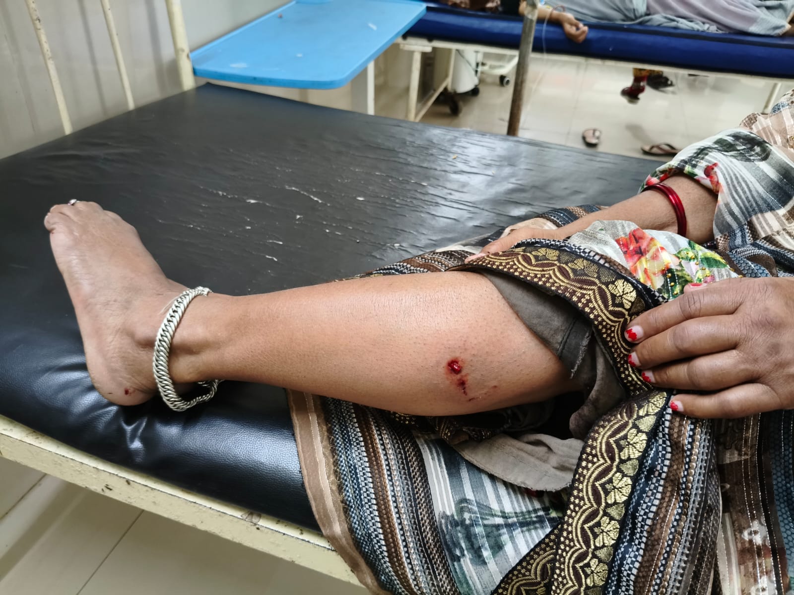सीहोर जिले के ग्राम सोटिया में जंगली सियार का हमला: 8-10 लोग घायल