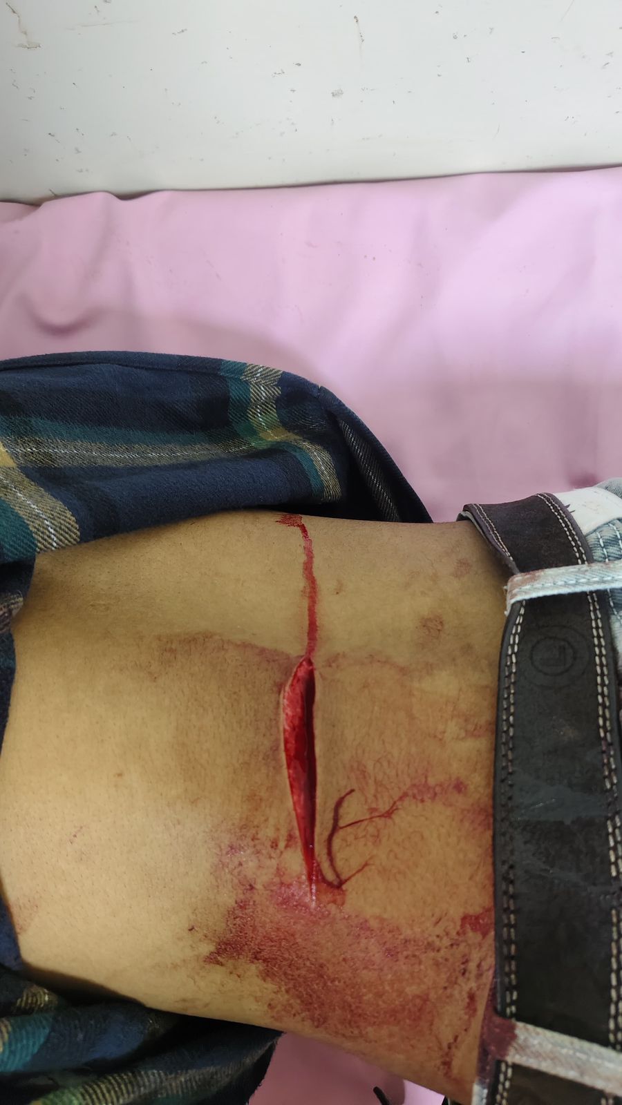 भोपाल: तलैया थाना क्षेत्र में युवक पर छुरी से हमला, हमीदिया अस्पताल में इलाज जारी