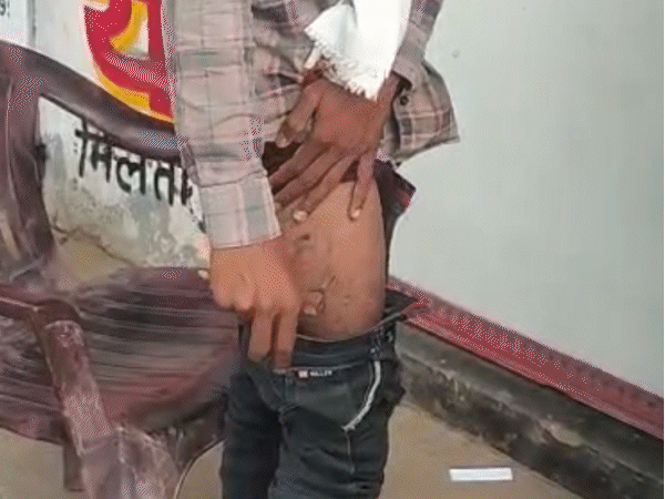 पन्ना: चलती स्कूटी पर जेब में फटा मोबाइल, झुलसा युवक