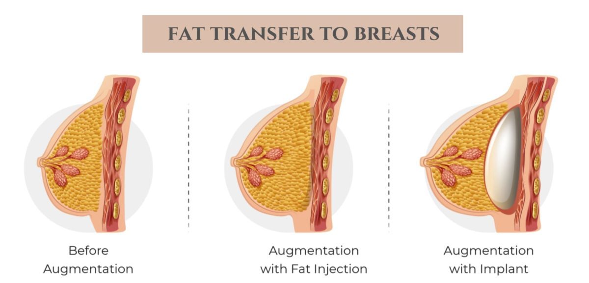 What Are Some Benefits and Drawbacks of Fat Transfer to Breasts? - WelfulloutDoors.com