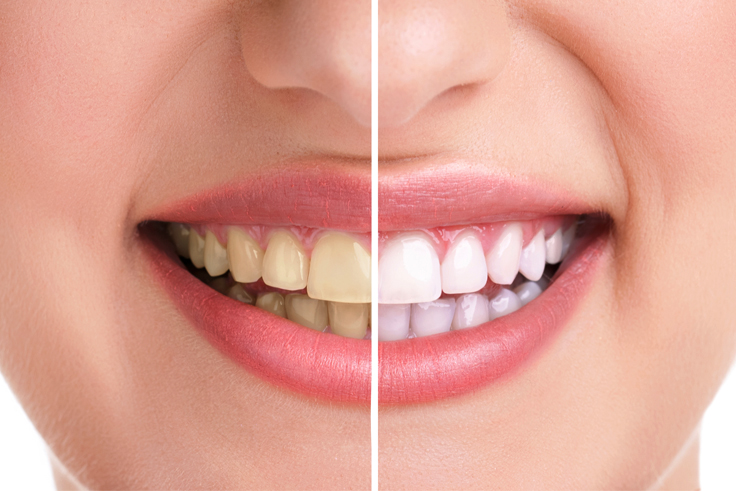 What Are The Cosmetic Dentistry Procedures To Enhance Your Teeth? | TheAmberPost