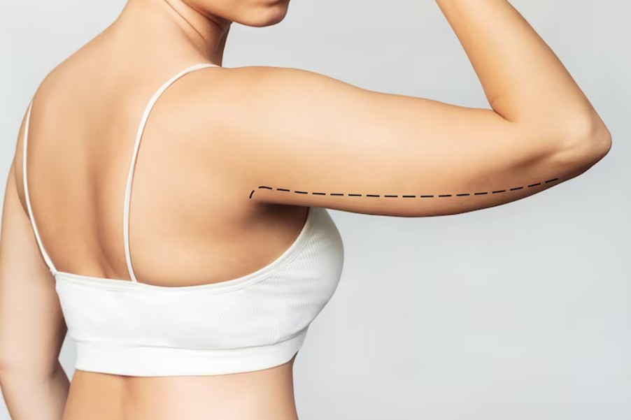 Types of Arm Liposuction and Things to Think About Before the Procedure - Let US Fit