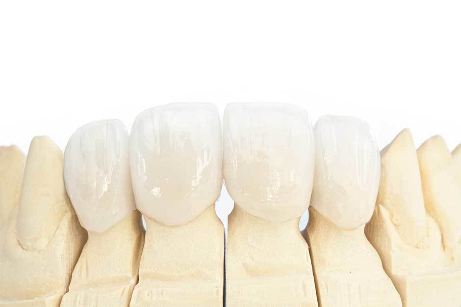 What Should You Know About Dental Implants?  | Zupyak