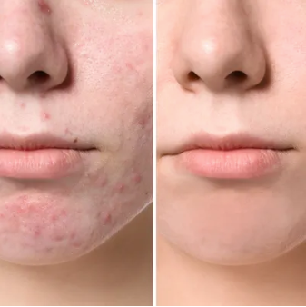 Key Benefits Of Laser Acne Scar Treatment | Zupyak