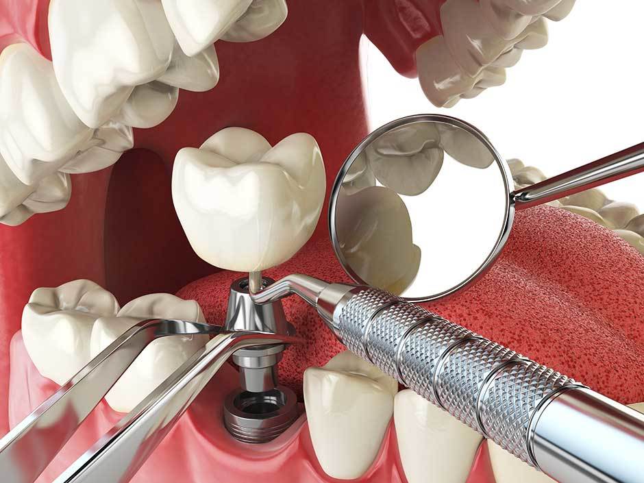 Considerations Before Getting a Dental Implant Done – Article Bowl – Bloggers Unite India