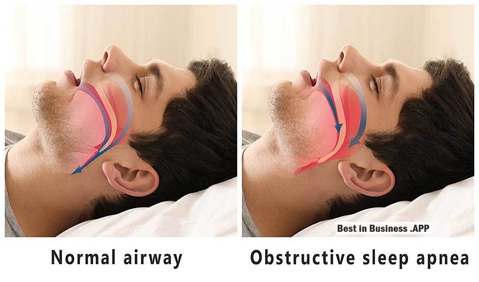 What Is Role Of Cpap And Bipap Therapy In Treating Sleep Apnea – Best in Business .App