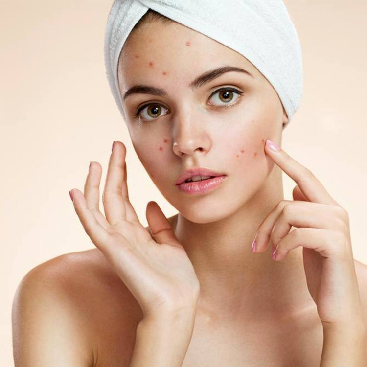 Acne Treatment In Chennai - Dermecure