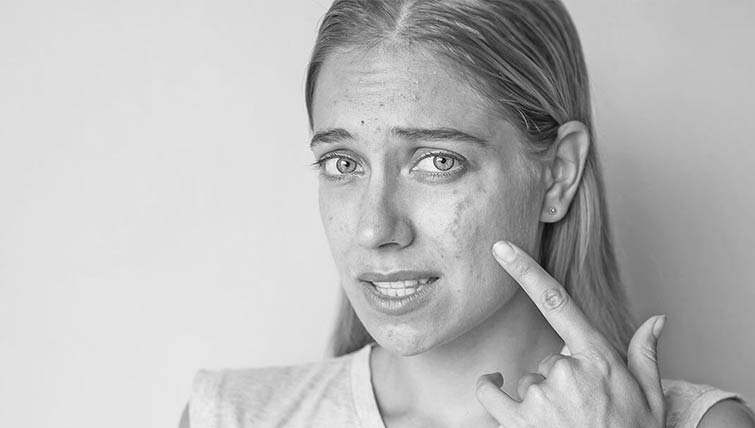 Acne Specialist Doctor in Delhi | Best Acne Treatment Clinic in South Delhi, Greater Kailash