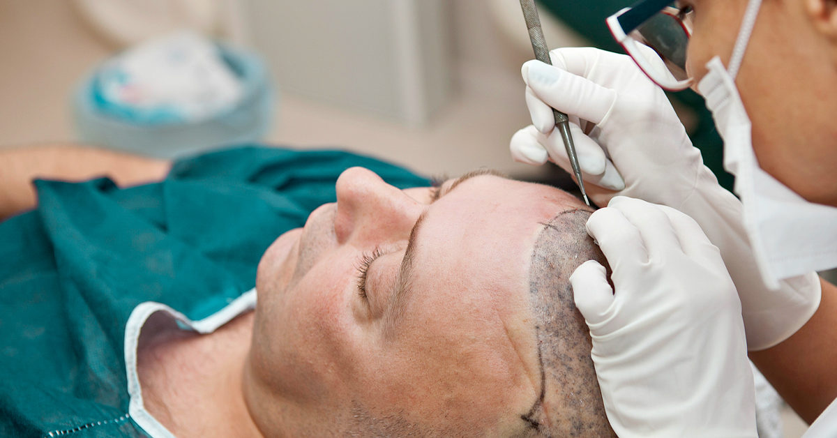 HAIR TRANSPLANT - The Hairsmith