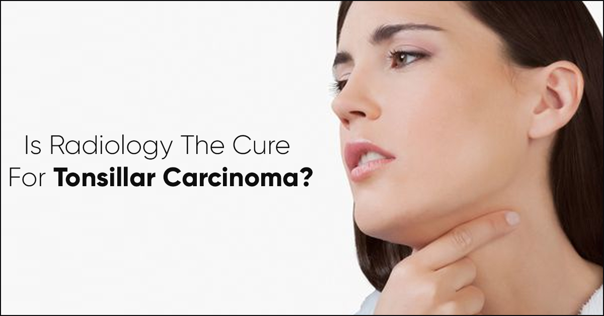 Tonsil Cancer : Symptoms, Survival Rate and Treatment