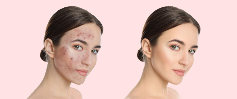 Chemical Peel Treatment In Delhi | Chemical Peel Cost In Delhi
