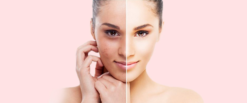Best Laser Treatment For Pigmentation In Delhi | Laser Pigmentation Removal Cost In Delhi