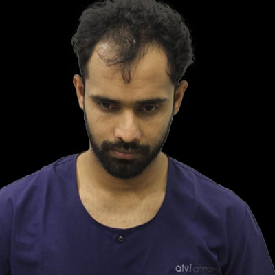 Hair Transplant Indore - Hair Transplant | Hair Replacement | Hair Loss