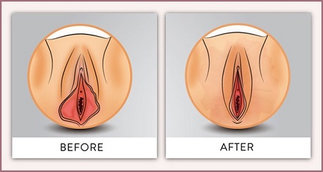 Cắt môi bé vùng kín - Kinh nghiệm chị em nên biết - Dr.Huy Giang