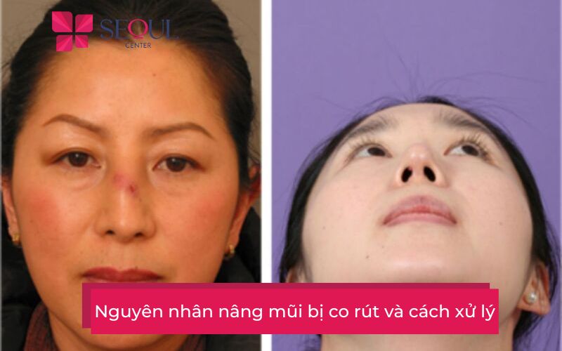 Nguyên nhân nâng mũi bị co rút và cách xử lý - Seoul Center