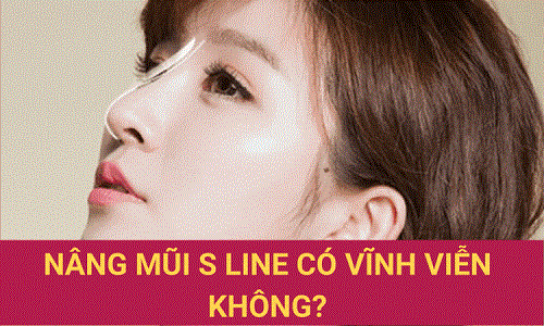 Nâng mũi S Line có vĩnh viễn không? Yếu tố ảnh hưởng độ bền mũi S line