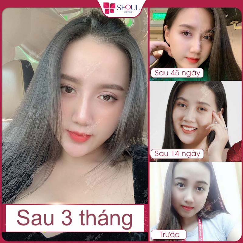 Hình ảnh và kết quả cắt mí mắt sau 1, 2, 3 ngày đến vài tháng