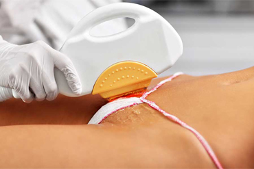 Лазерная эпиляция глубокого бикини - как проводится: видео