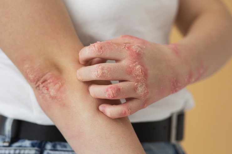 Eczema Treatment in Homeopathy